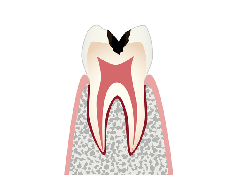 虫歯の進行と治療 C2 象牙質の虫歯