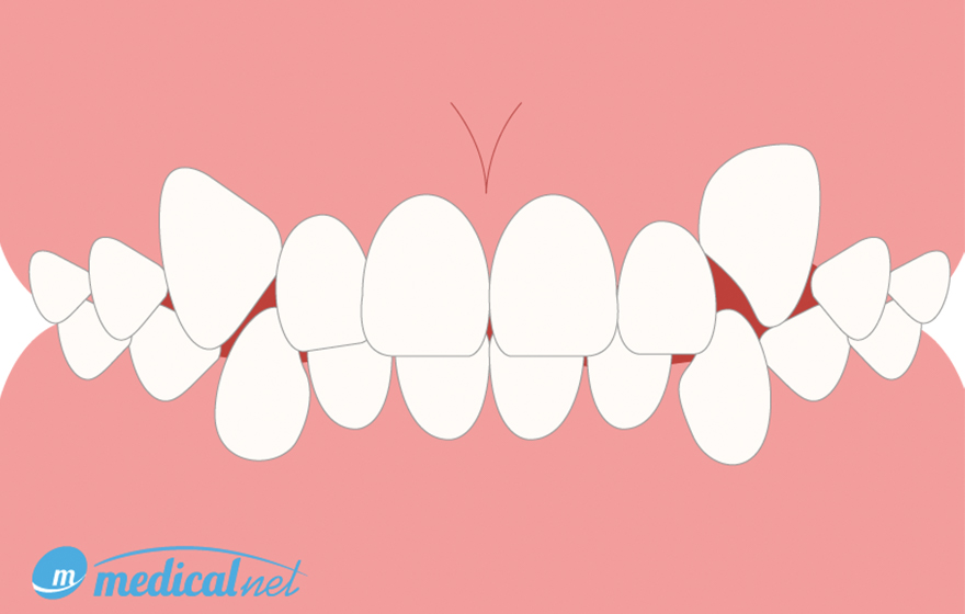 さまざまな歯並びの症状 八重歯