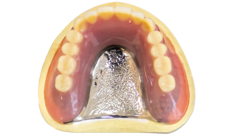 金属床 総入れ歯（コバルトクロム合金）