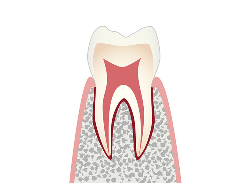 虫歯の進行と治療 C0 初期の虫歯