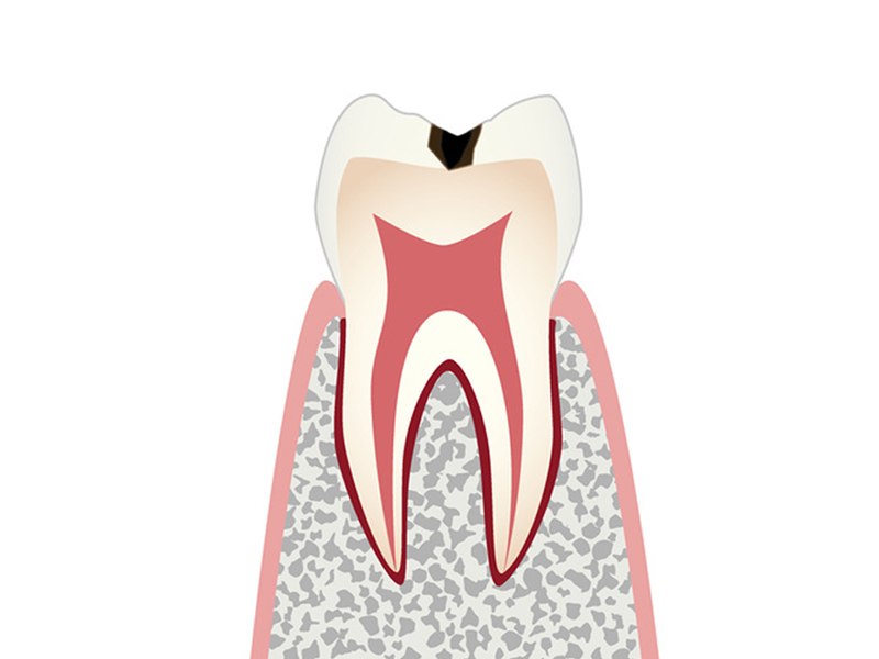 虫歯の進行と治療 C1 エナメル質の虫歯