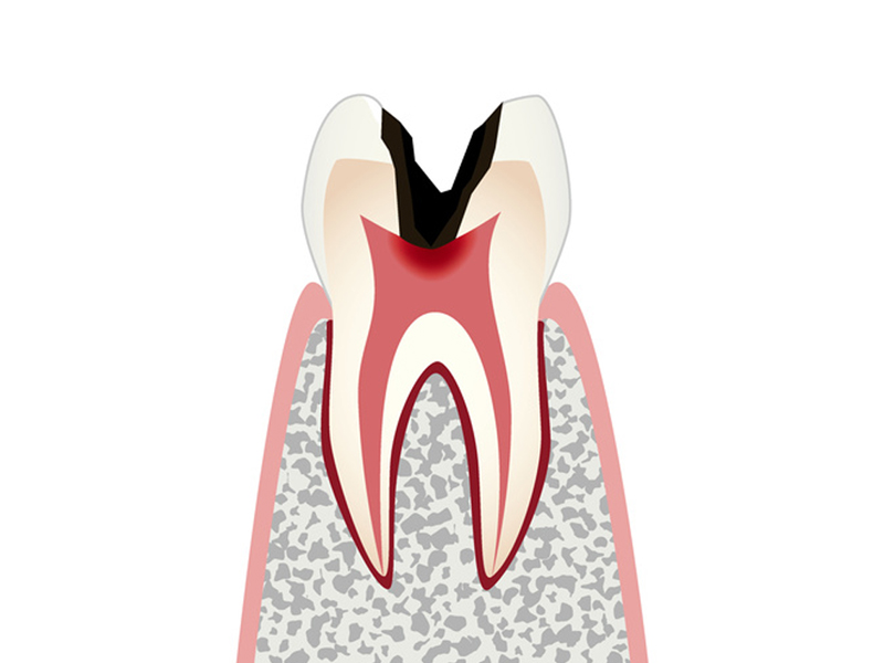虫歯の進行と治療 C3 歯髄の虫歯