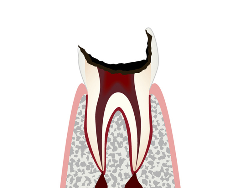 虫歯の進行と治療 C4 残根の虫歯