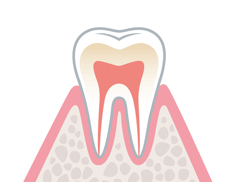 歯周病の原因と進行 歯肉炎