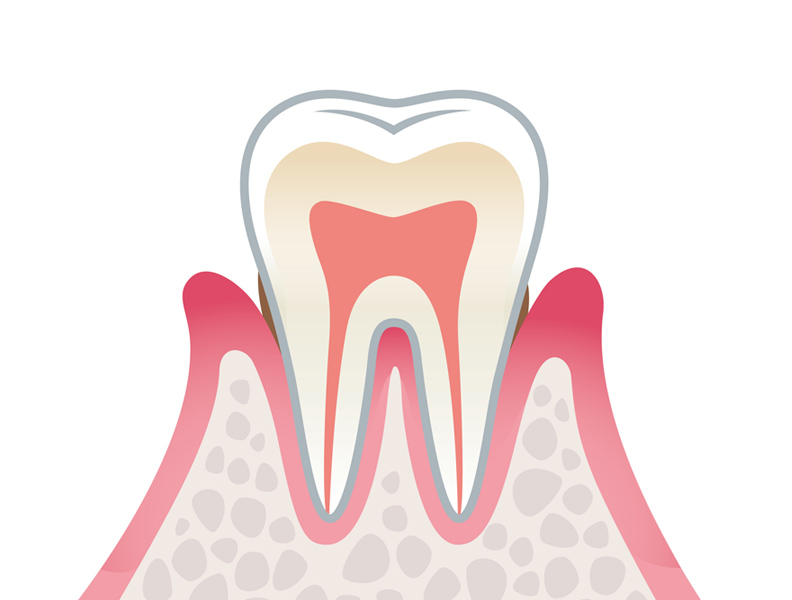 歯周病の原因と進行 軽度歯周炎