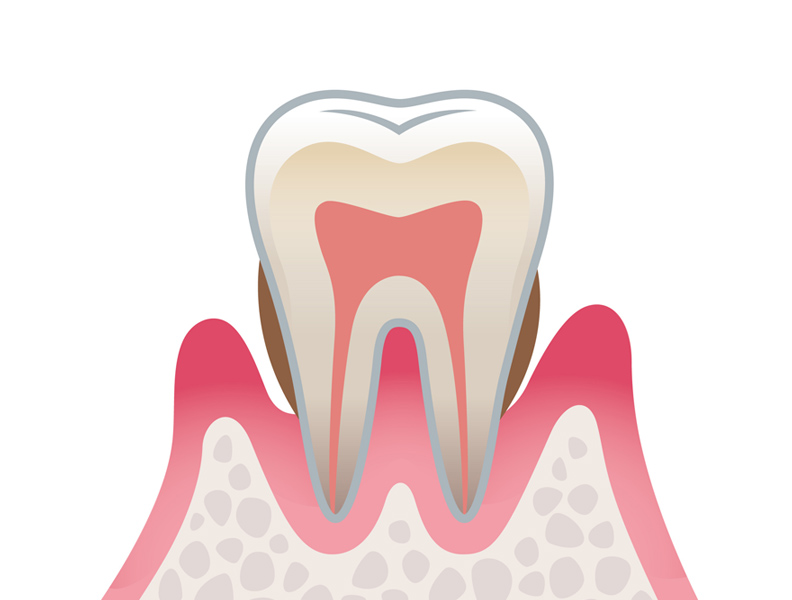 歯周病の原因と進行 中度歯周炎
