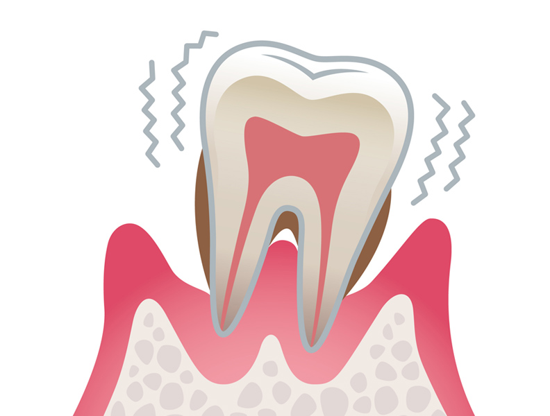 歯周病の原因と進行 重度歯周炎