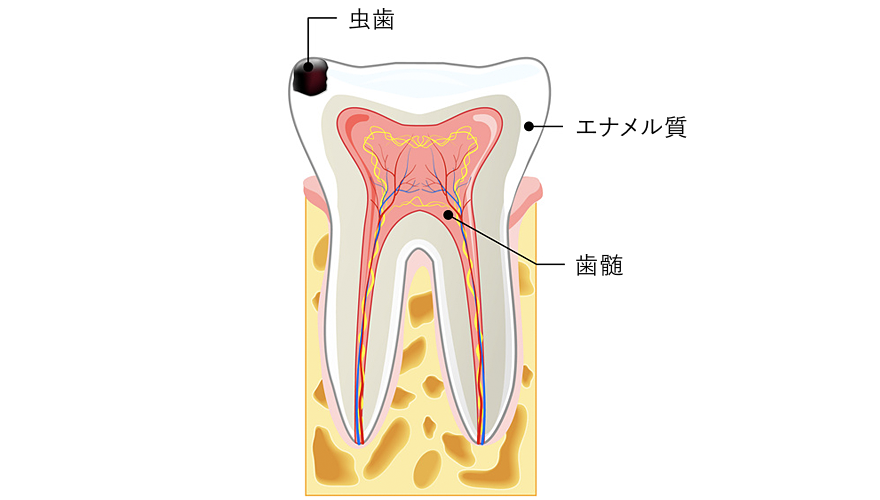 根管治療 歯髄炎