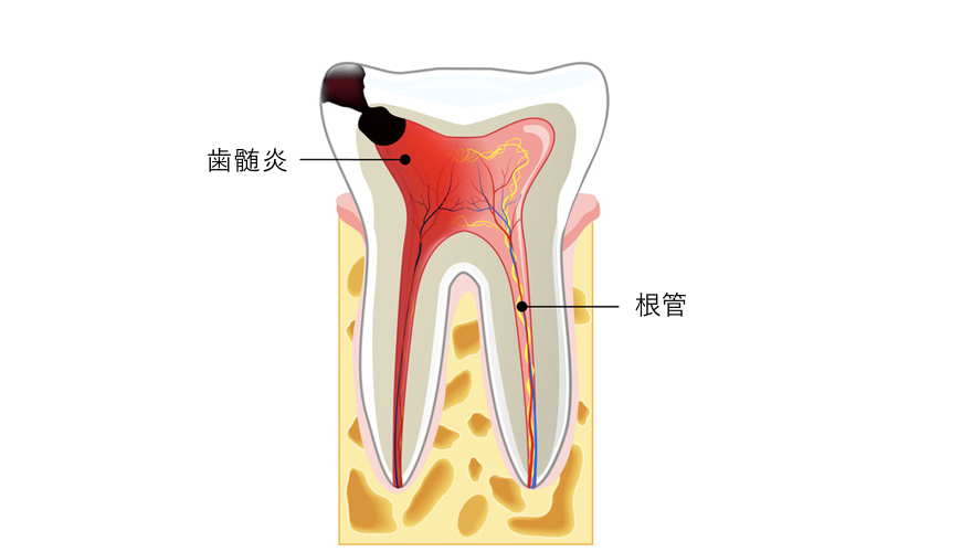 根管治療 歯髄壊死