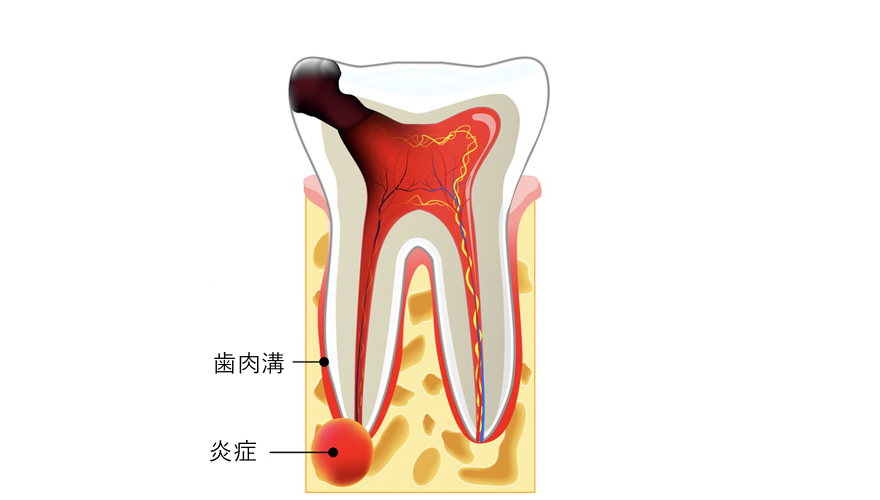 根管治療 根尖性歯周炎（こんせんせいししゅうえん）