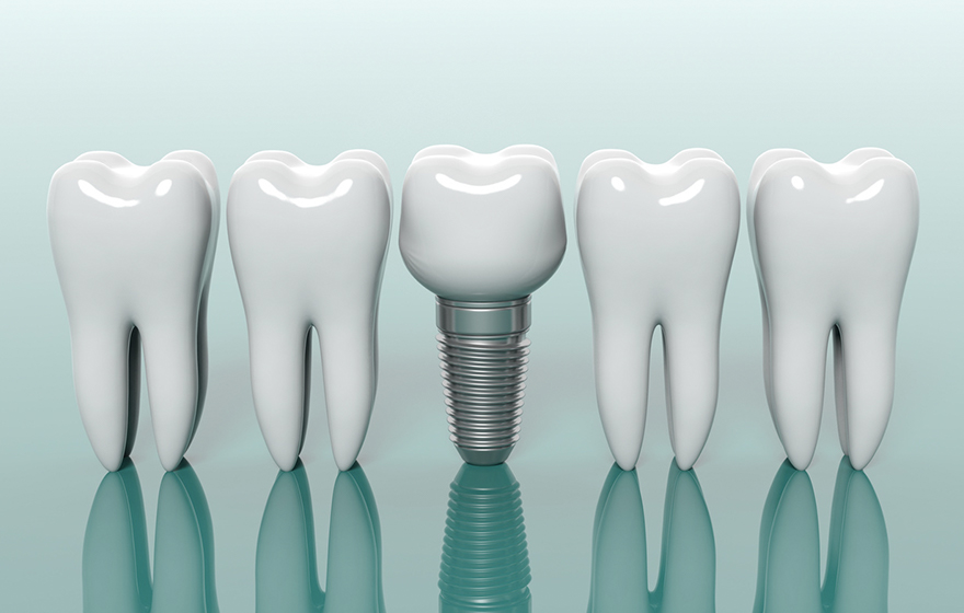インプラント治療とは