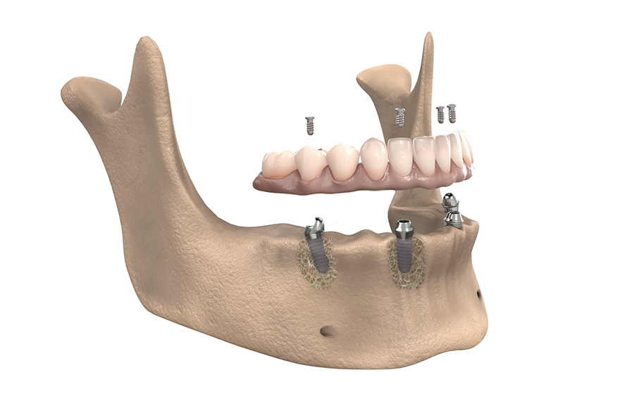 インプラント治療の方法 All-on-4