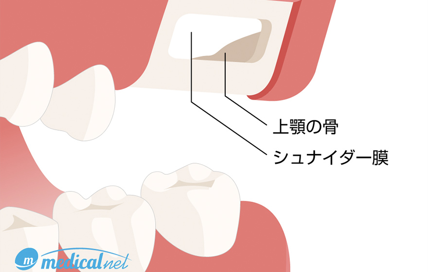 サイナスリフト（上顎洞挙上術）