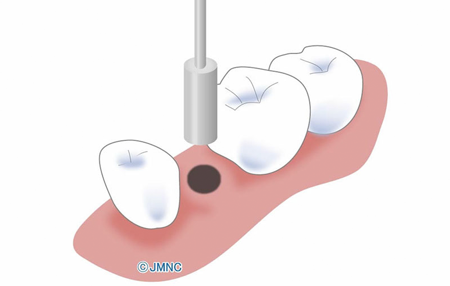 インプラント治療の方法 フラップレスインプラント