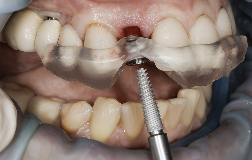 インプラント治療の方法 抜歯即時荷重