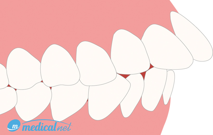 さまざまな歯並びの症状 出っ歯（上顎前突）